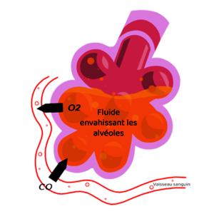 fluide envahissant les alvéoles empêchant les alvéoles de fournir le dioxygène au sang