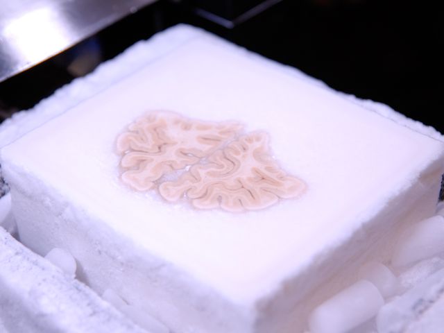cerveau congelé d