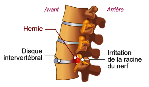 Je Souffre D Une Hernie Discale Questions Frequentes Une Question En Sante Cite De La Sante Lieux Ressources Au Programme Cite Des Sciences Et De L Industrie