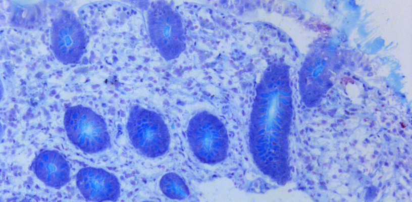 Coupe histologique du côlon d’un patient atteint par la maladie de Crohn. La pathologie est caractérisée par la diminution de la présence du mucus (bleu clair) dans la lumière des cryptes coliques (bleu foncé). Coloration au bleu Alcyan. Microscopie optique. Image réalisée à l’unité mixte de recherche 1220, Institut de recherche en santé digestive (IRSD), Toulouse. ©Inserm/Céline Deraison