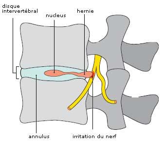 Qu'est-ce qu'une hernie discale lombaire ? - Maladies (autres que ...